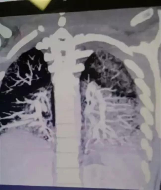 Rendgenski snimak pluća mladića nakon pušenja električne cigarete - Avaz
