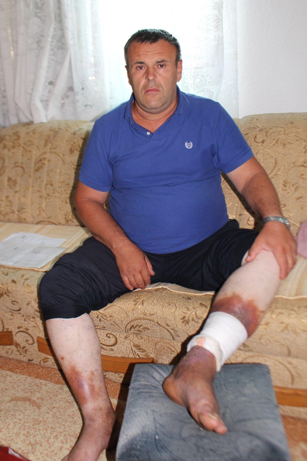 Otvorene rane na nogama borca Hasana Smajića - Avaz