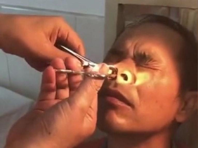 Kina: Pacijent nije mogao vjerovati šta mu je doktor izvukao iz nosa