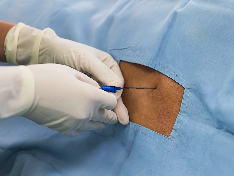 Dobre i loše strane epiduralne anestezije