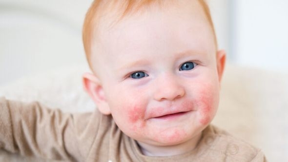 Veza između atopijskog dermatitisa i hrane
