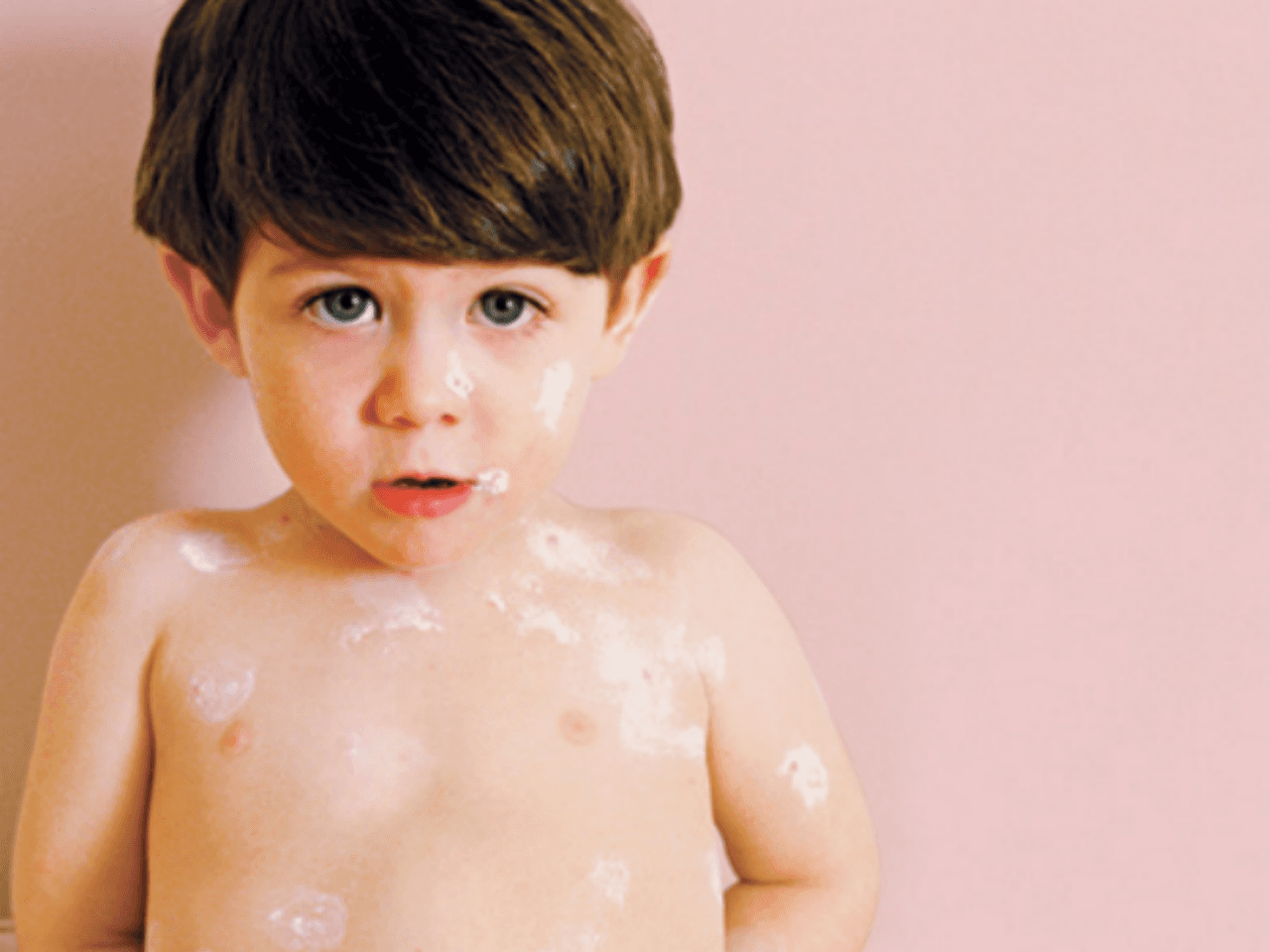 Atopijski dermatitis i astma djece