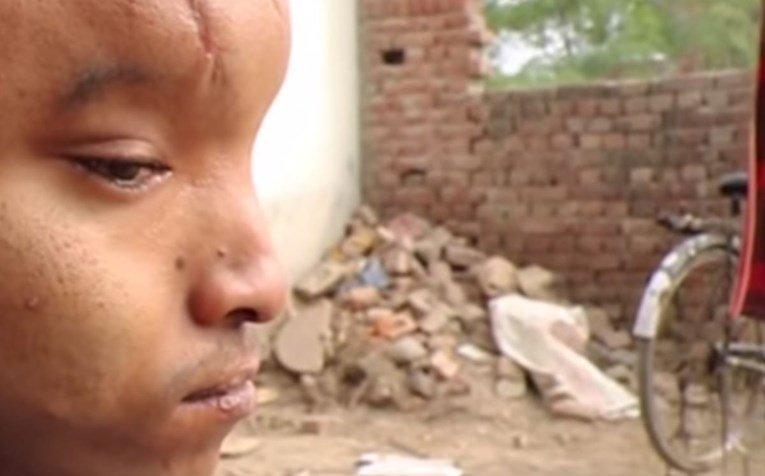 Muškarca iz Indije zbog deformirane glave zovu "vanzemaljac"