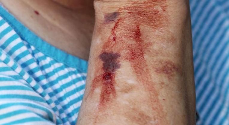 Teško stanje bake koja je pretučena dok je ležala u Zemunskoj bolnici: Ljekari je uveli u komu