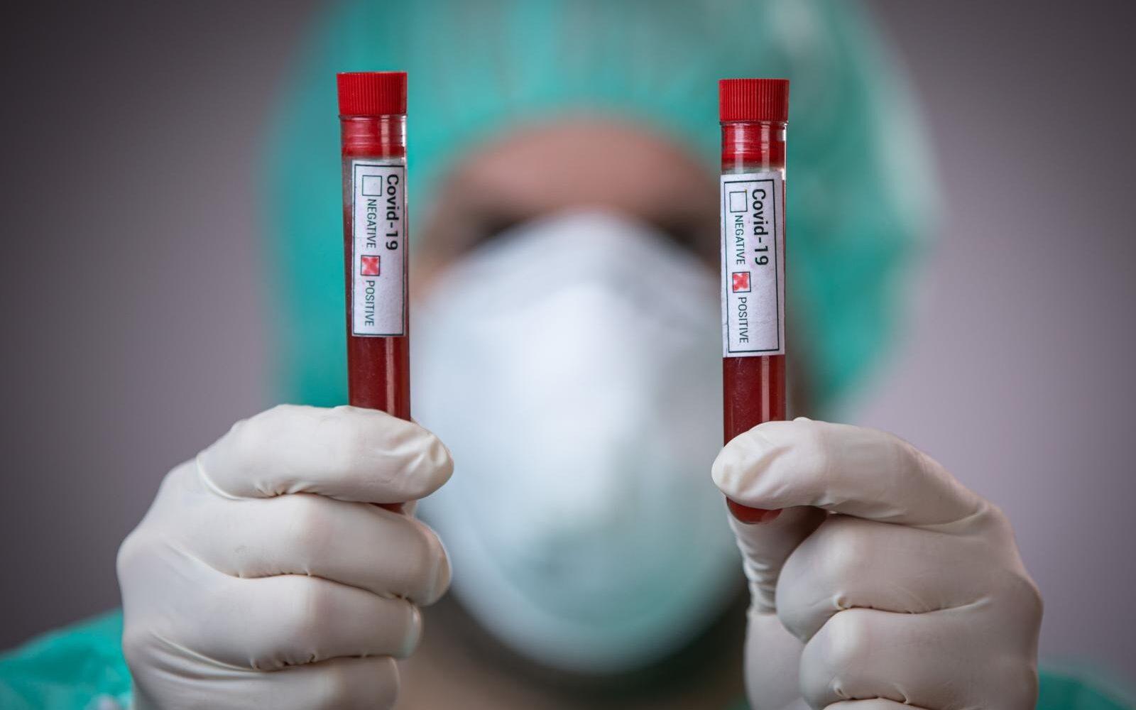 UNDP donirao 3.000 testova za koronavirus Institutu za javno zdravstvo RS