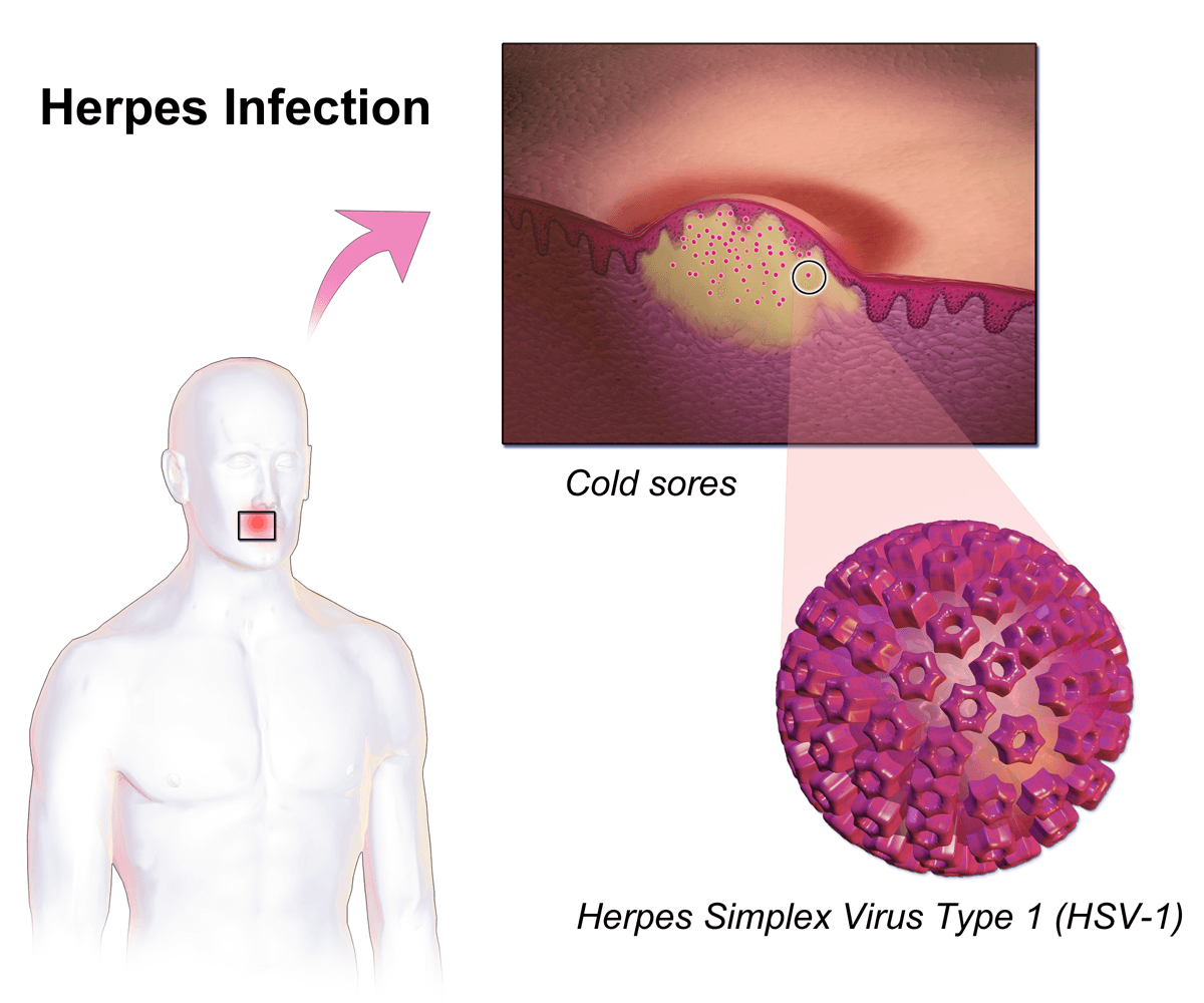 HSV-1 uobičajeno izaziva herpes na usnama - Avaz