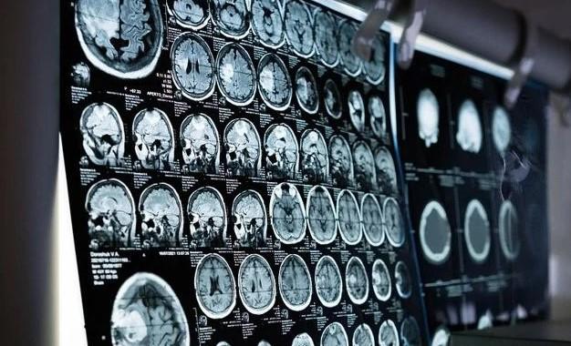 Naučnici snimali mozak čovjeka u trenutku smrti i došli do zapanjujućih otkrića