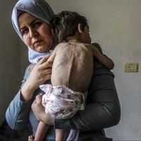 Vlada u Gazi: Oko 3.500 djece u opasnosti od smrti zbog pothranjenosti
