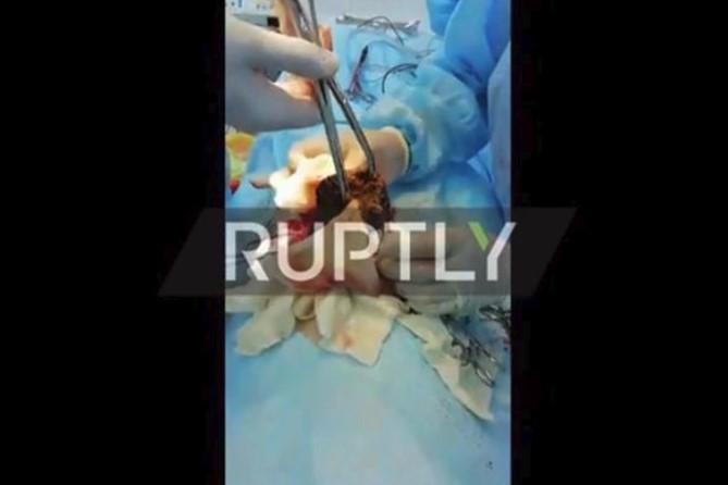 Djevojčici operacijom uklonjeno 3,5 kilograma dlaka iz trbuha