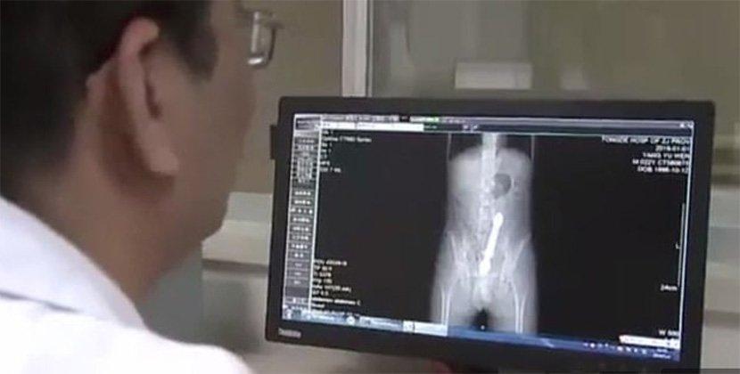 Muškarac u Kini u anus gurnuo staklenu šipku od 20 centimetara, pa završio na operaciji