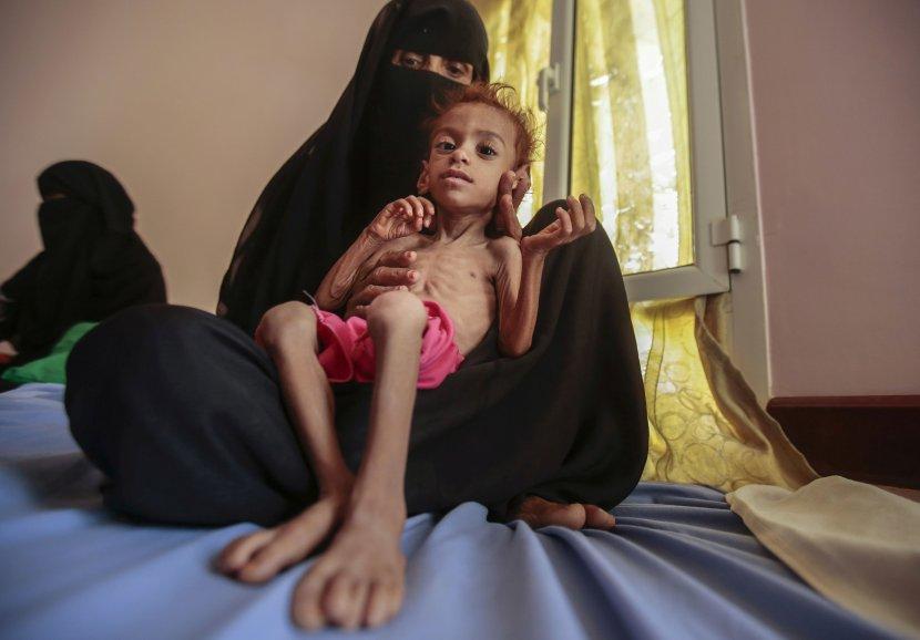 Deca u Jemenu umiru od gladi - Avaz