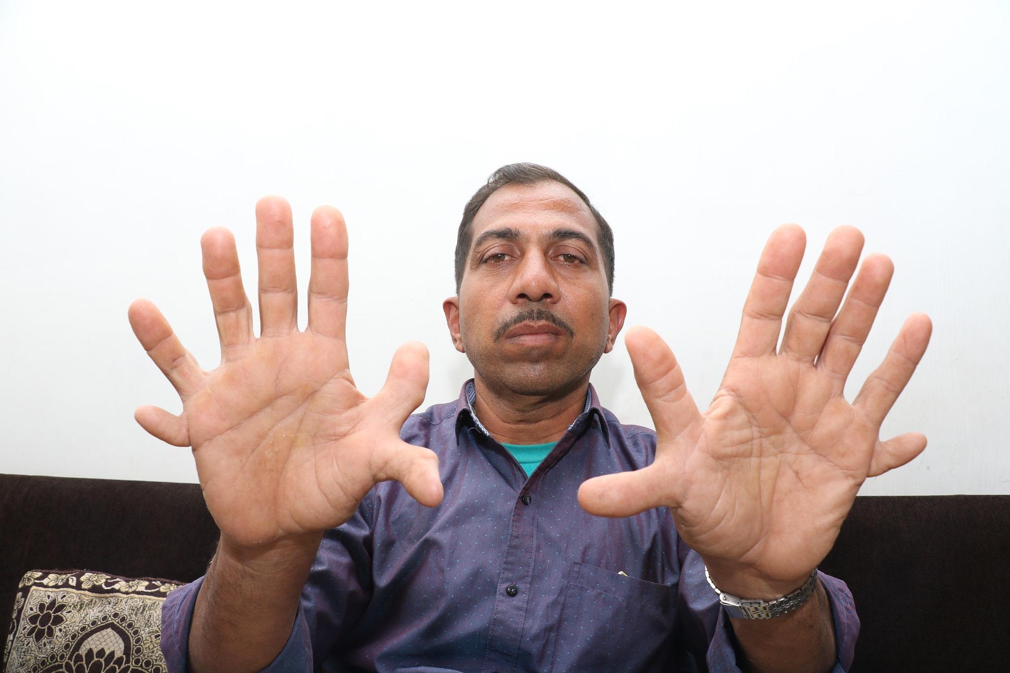Devendra Suthar ima 28 prstiju - Avaz
