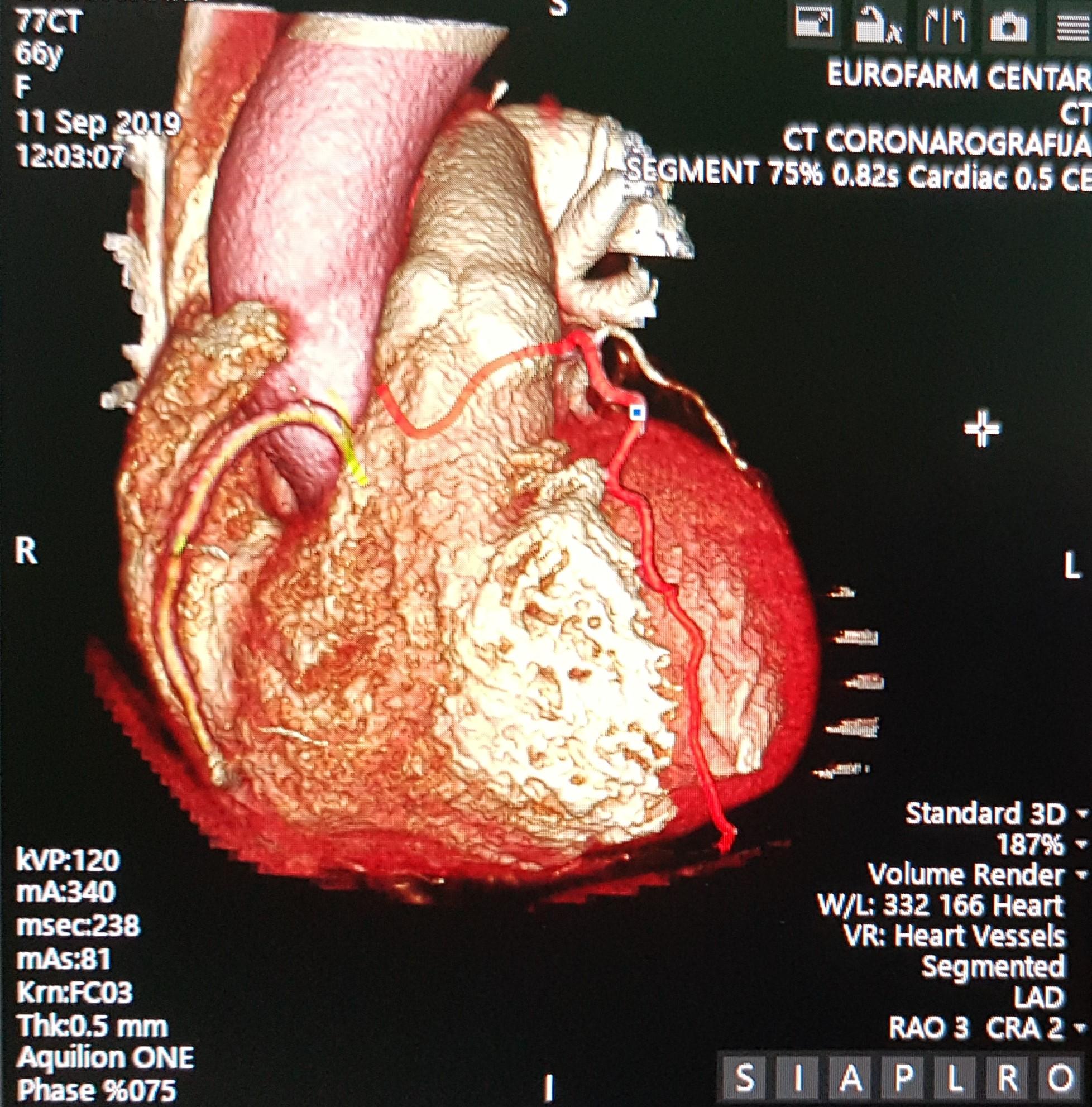 CT Coronarografija - Avaz