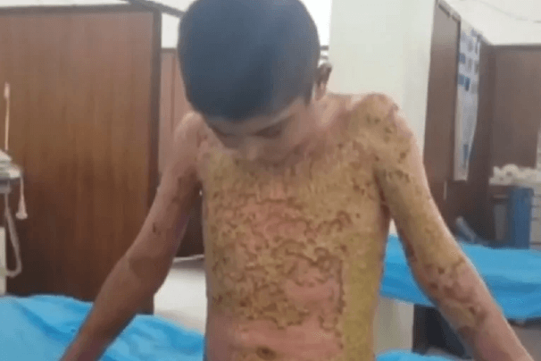 Potresne fotografije dječaka iz Sirije kojeg je spalilo hemijsko oružje