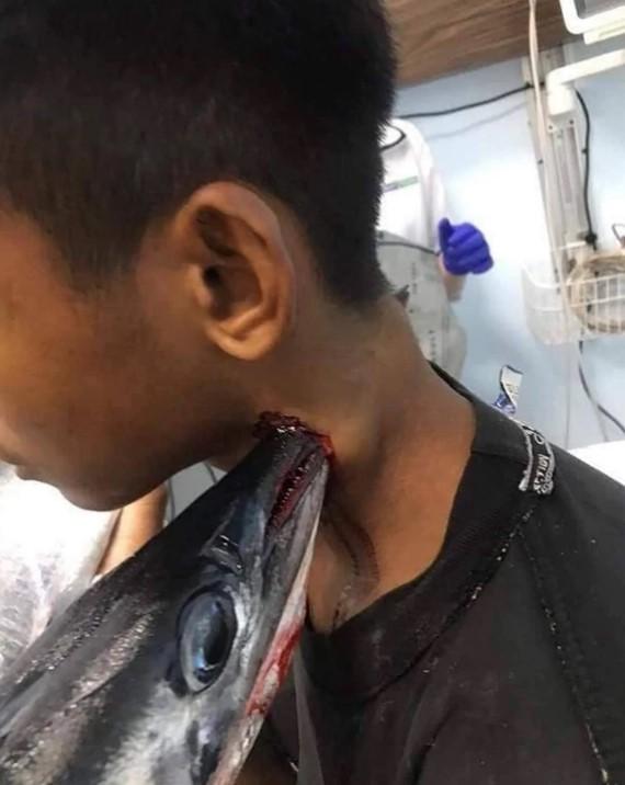 Riba igličarka povrijedila 16-godišnjaka - Avaz