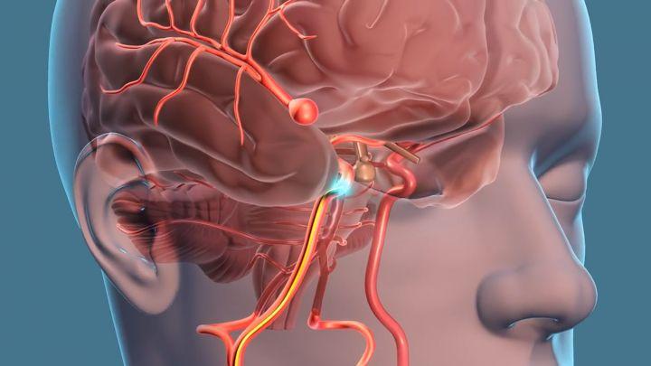 Mozak novi biomaterijal – lijek za aneurizme