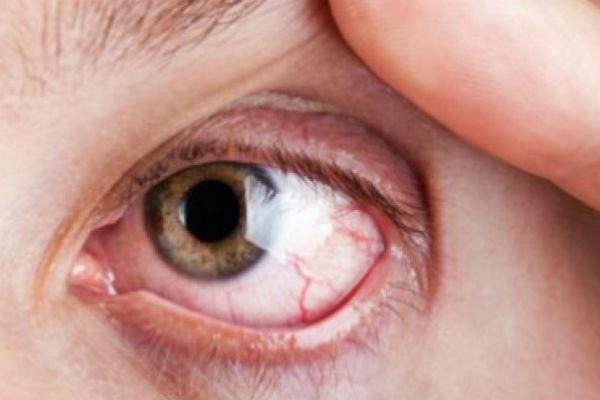 Spriječite iritaciju oka