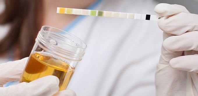 Oštećenje tkiva bubrega otkriva se analizom urina - Avaz