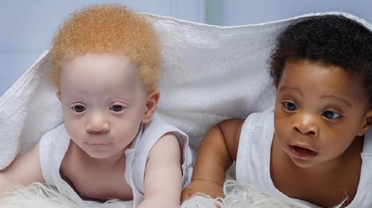 Preslatki blizanci postali zvijezde: Rođeni su s različitom bojom kože