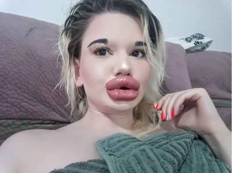 Ova djevojka želi imati najveće usne na svijetu