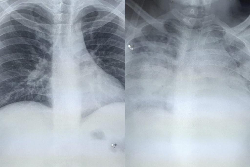 Hirurg iz Kragujevca objavio snimak pluća pacijenta koji je umro za dva dana