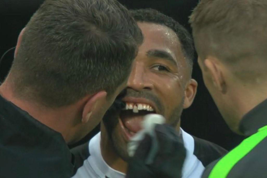 Fudbaleru Njukasla morali vraćati zub nakon duela sa igračem Arsenala