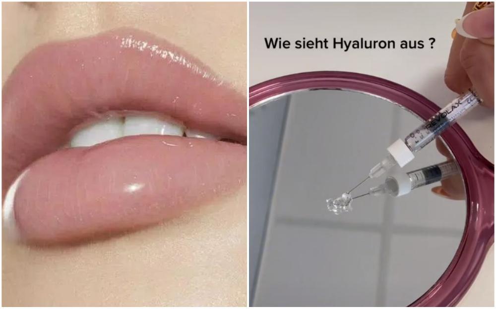Da li ste se pitali kako izgleda hijaluron koji se stavlja u usne?
