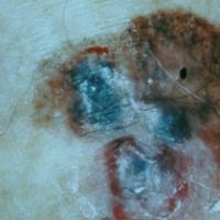 Rano liječenje pigmentiranih 
madeža može spasiti život