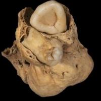 U tijelu drevne Egipćanke pronađen čudan tumor sa zubima
