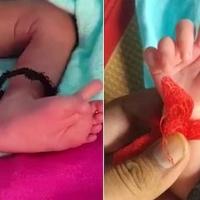 U Indiji rođena beba sa 26 prstiju, roditelji oduševljeni