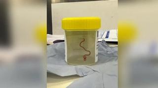 Australki ljekari iz mozga izvadili živog crva dugog osam centimetara