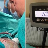 U Banjoj Luci ženi odstranjen tumor težak 23 kilograma