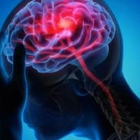 Ljekari upozoravaju na neobičan simptom moždanog udara