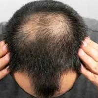 Otkrivena veza između testosterona i gubitka kose kod muškaraca