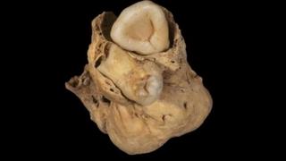 U tijelu drevne Egipćanke pronađen čudan tumor sa zubima