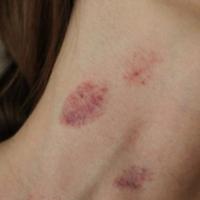 Žena nakon ljubavnog ugriza doživjela moždani udar: "Šljiva" na vratu nije bezazlena