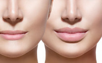 Komparacija usana prije i poslije filera