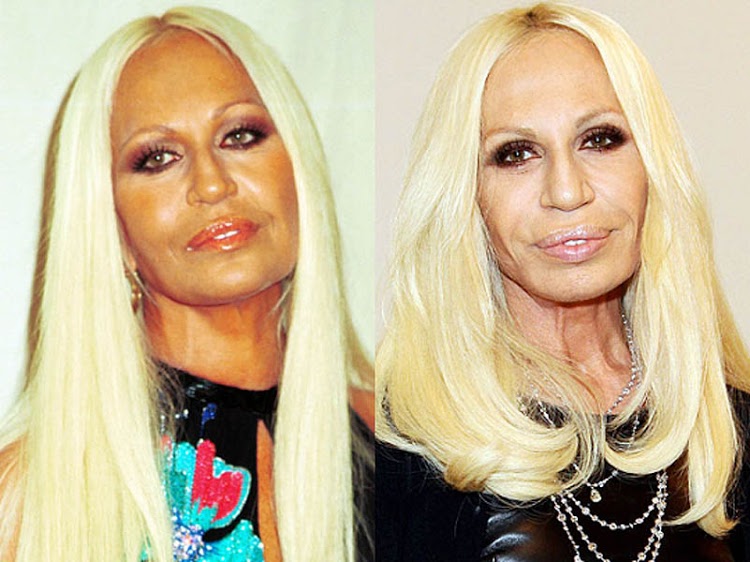 How much plastic surgery discount has donatella versace had